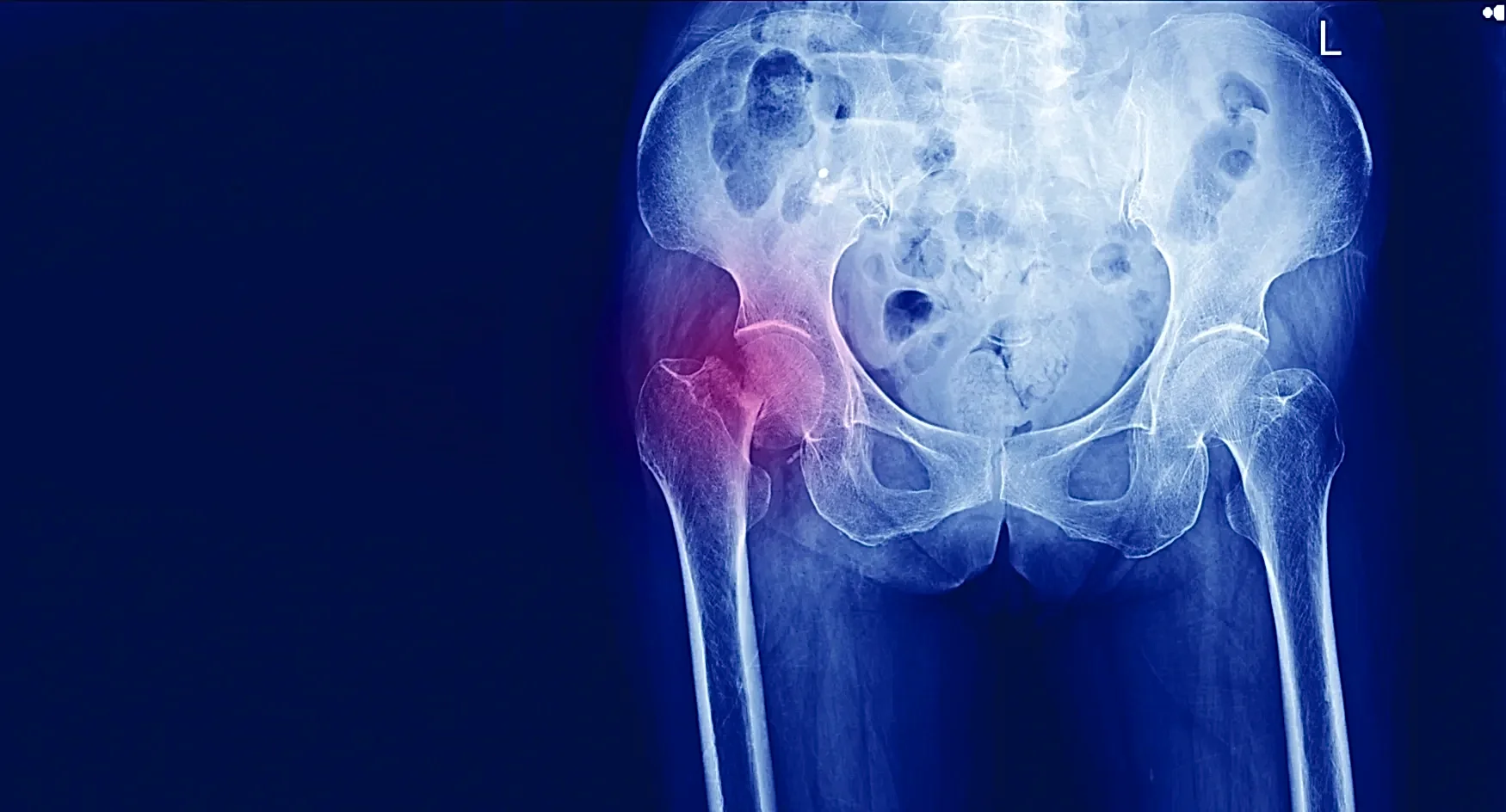 Как распознать и лечить перелом шейки бедра у пожилых 